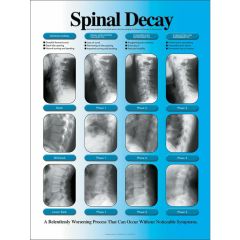 Laminated Spinal Decay Chart