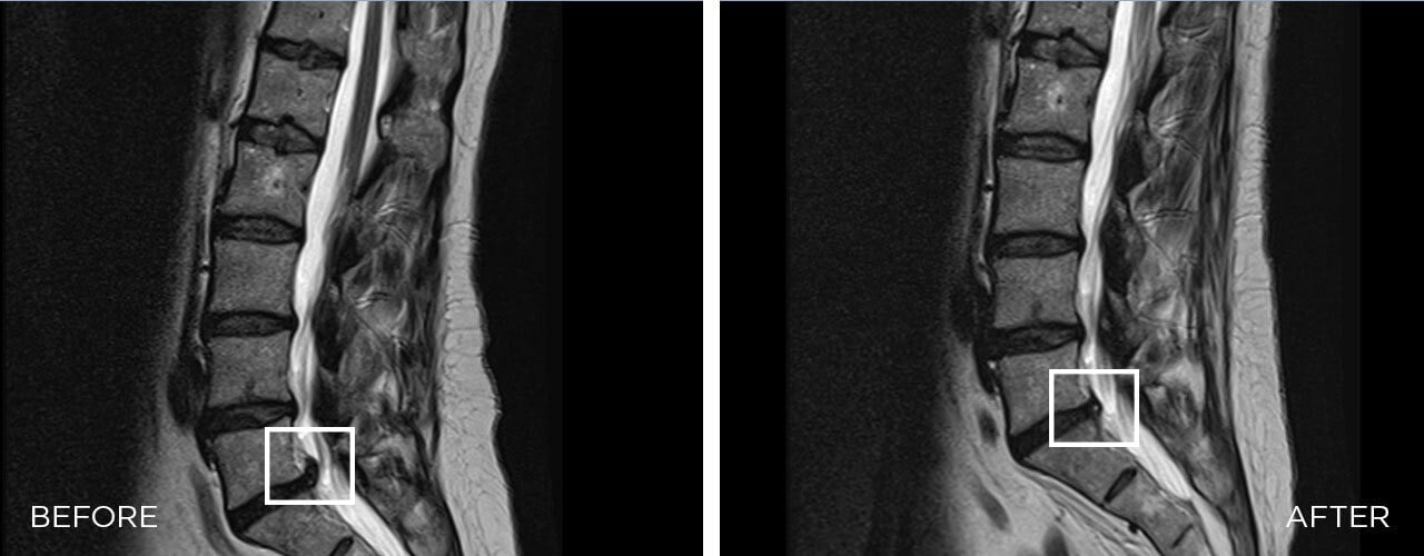 Btl Spinal Decompression 